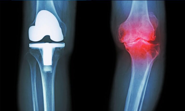 Totalendoprothese Fitnesstraining ENFORM